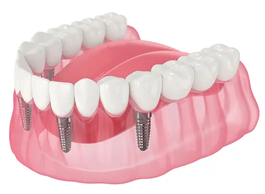 4Implant-Supported-Dentures 4 Implant Supported Dentures- All Michigan Implants