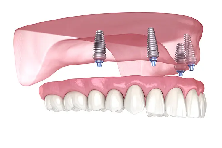 Say Goodbye to Loose Dentures with All-on-4 Say Goodbye to Loose Dentures with All-on-4