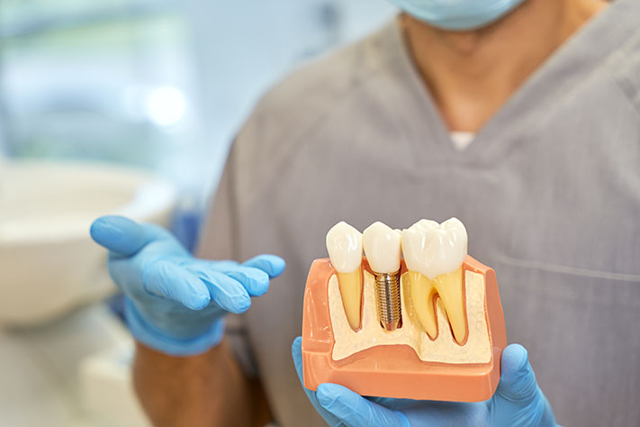 Dental Implants in Florida for a Confident, Natural-Looking Smile