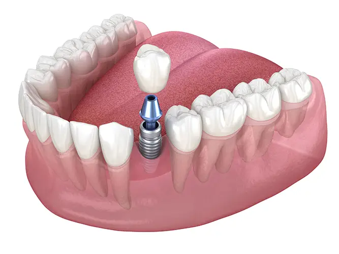 Dental-Implants Dental Implants- All Michigan Implants