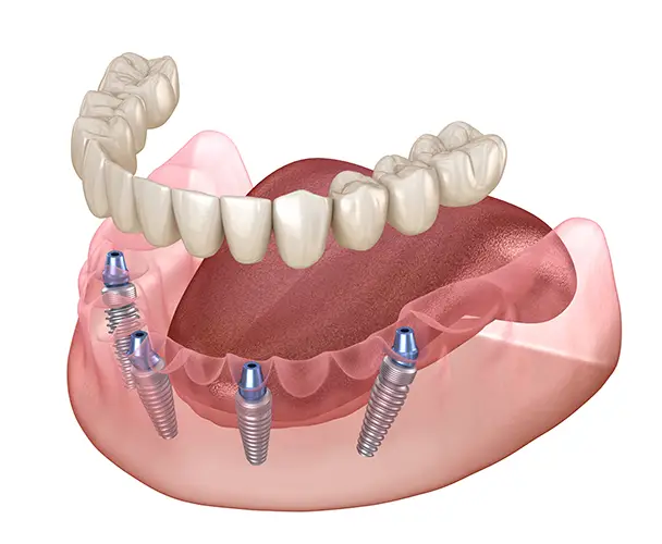 Permanent-Teeth Permanent Teeth- All Michigan Implants